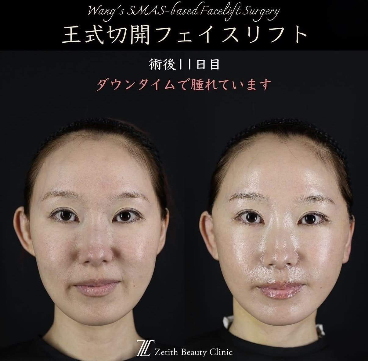 王医師による切開リフトの術前/術後11日 After 