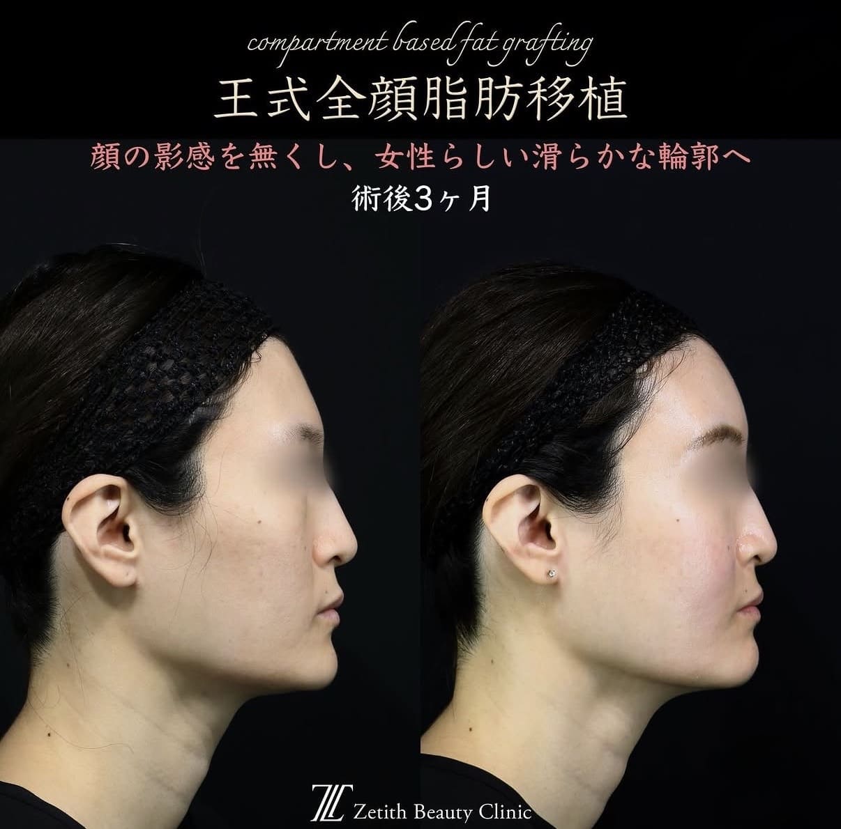 王医師による複合施術の術前/術後3ヶ月 Дараа 
