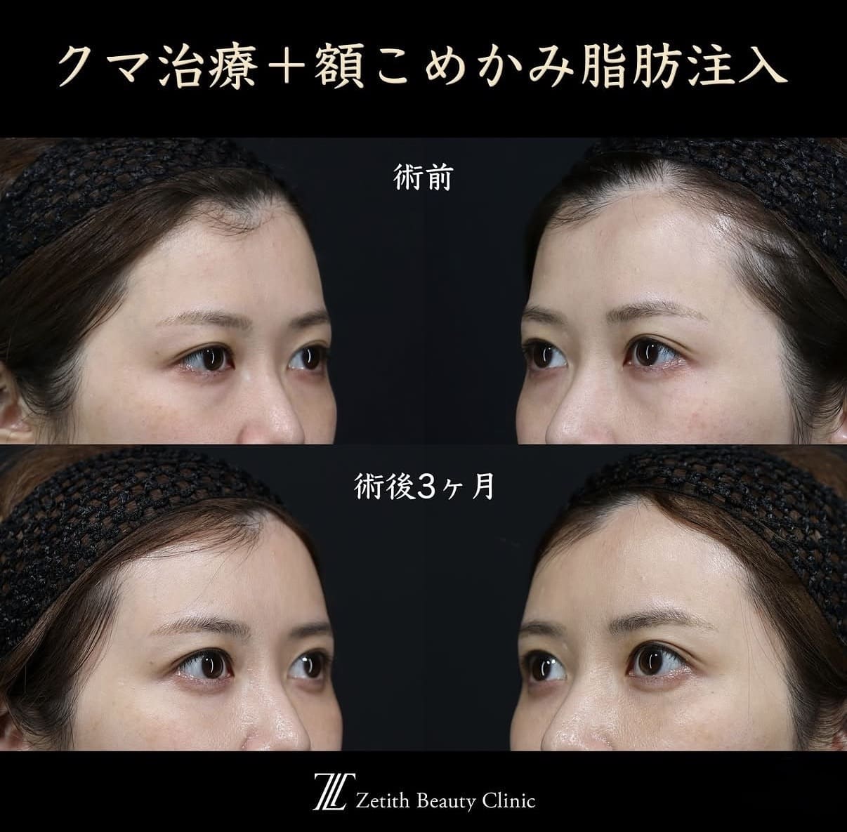王医師による複合施術の術前/術後3ヶ月 Sonra 
