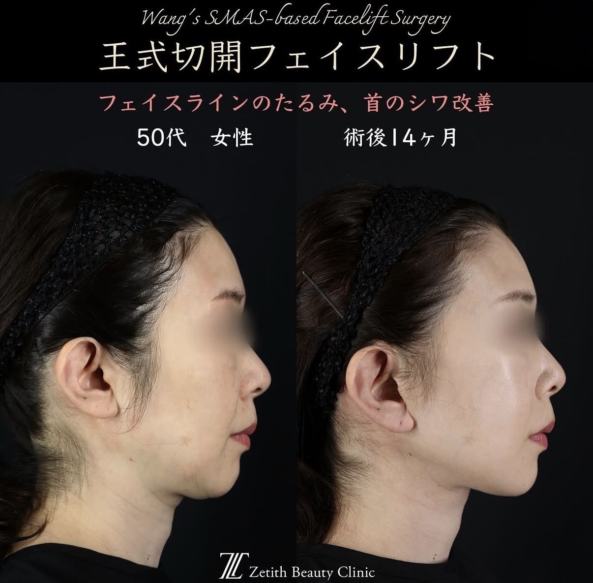 切開リフト