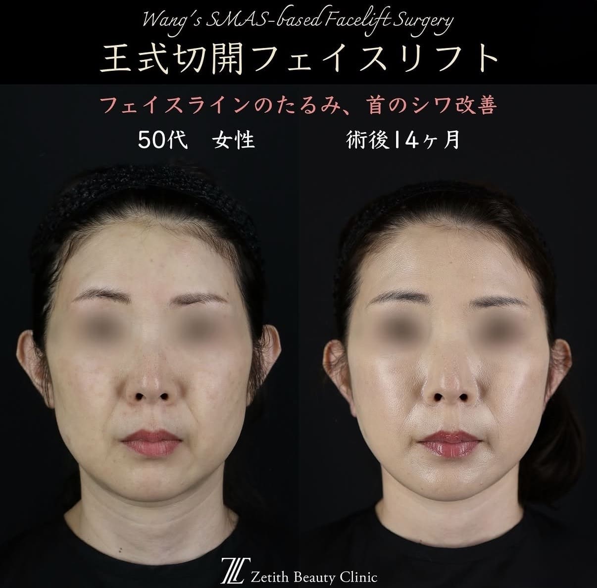 王医師による切開リフトの術前/術後14ヶ月 术后 