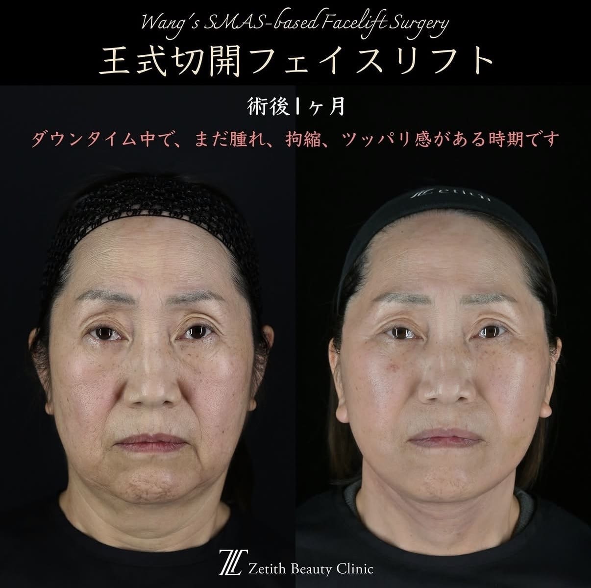 王医師による切開リフトの術前/術後1ヶ月 施術後 
