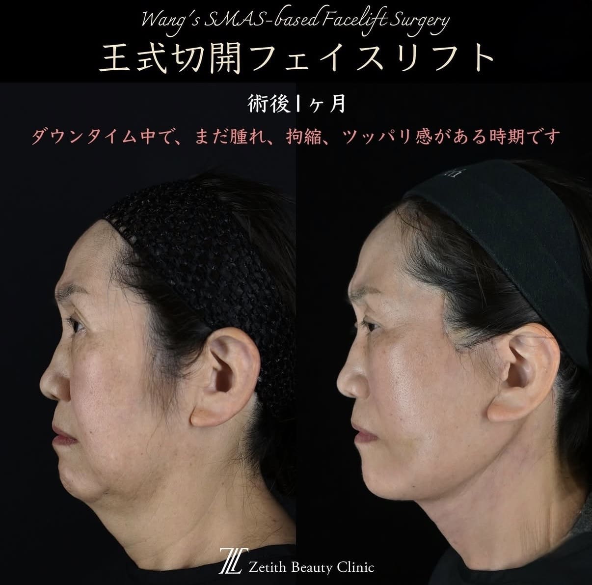 切開リフト
