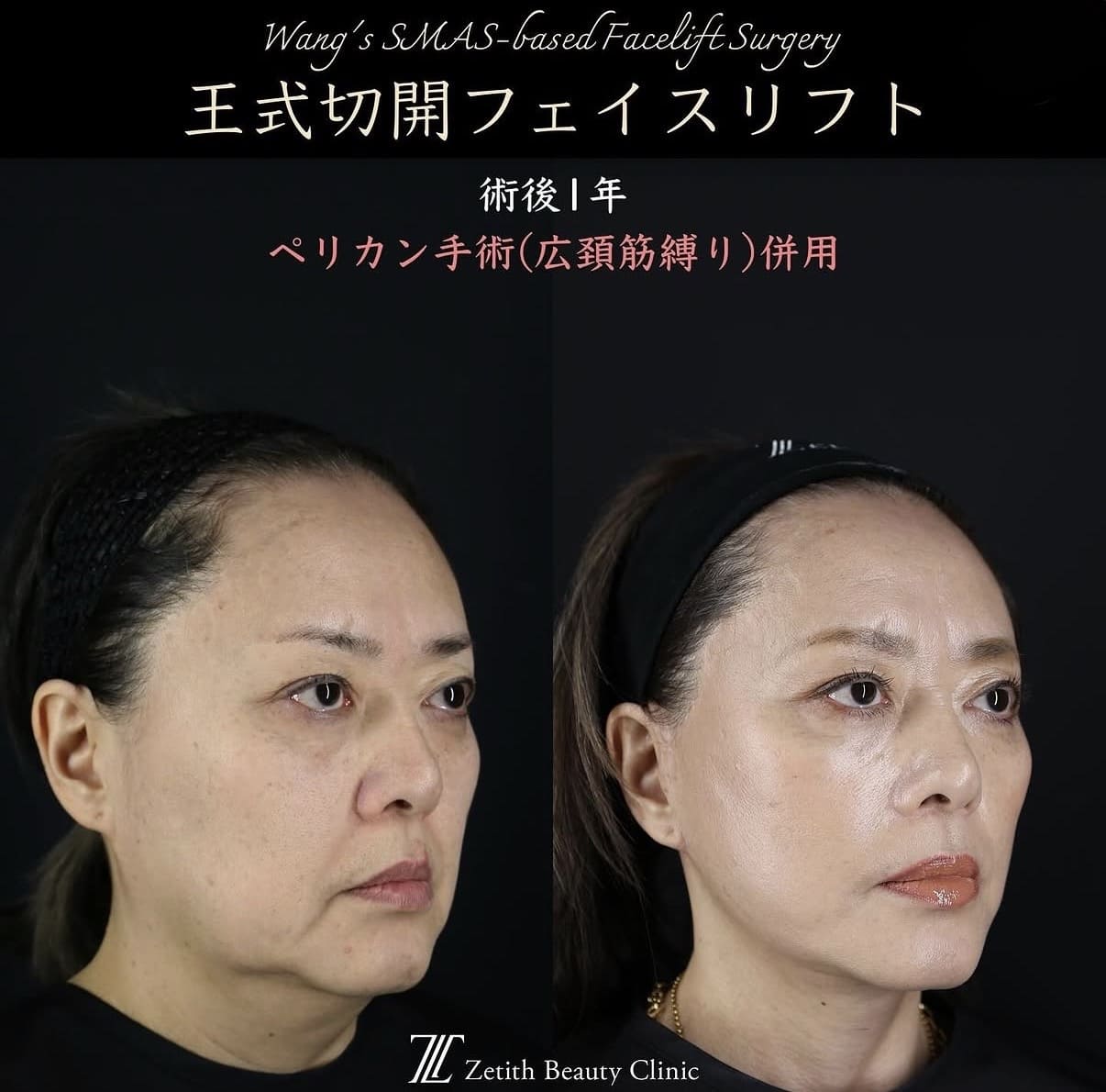 切開リフト