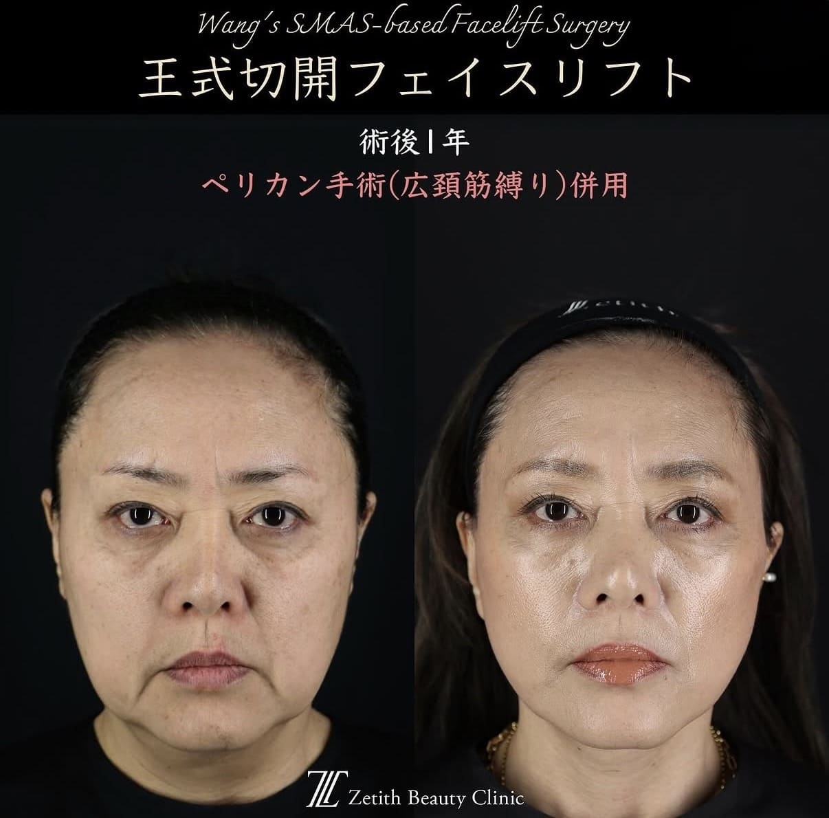 王医師による切開リフトの術前/術後1年 施術後 