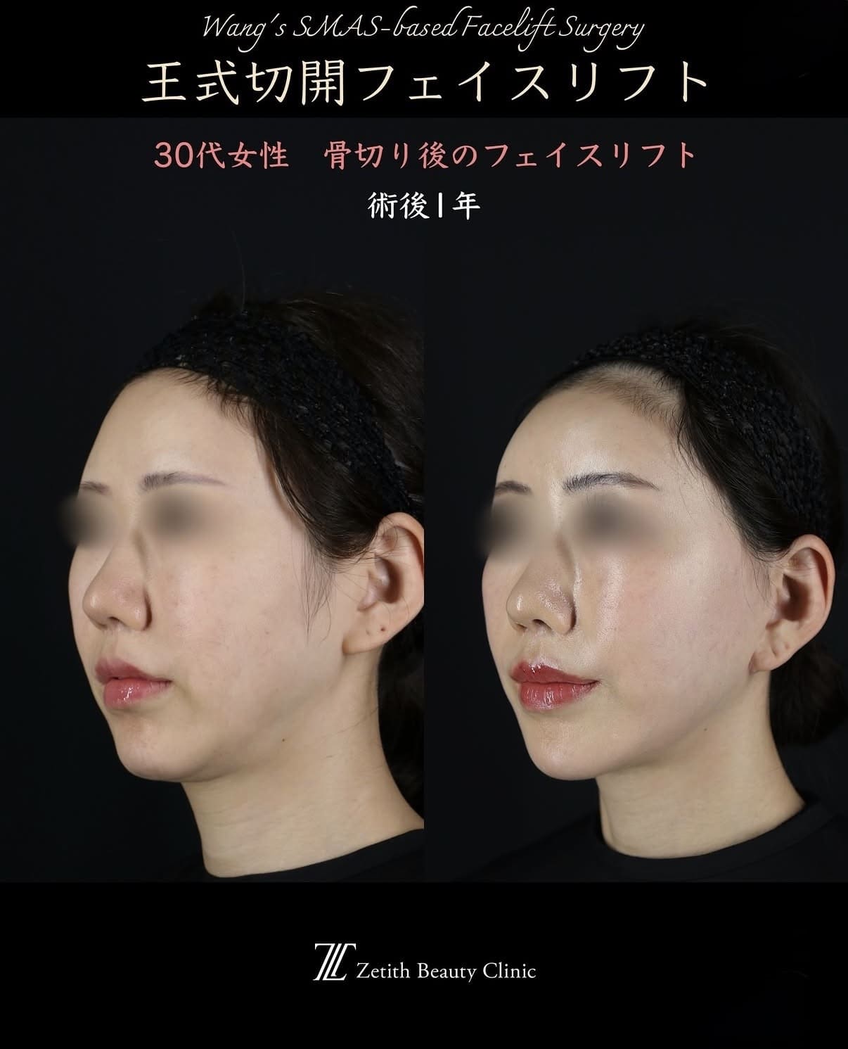 切開リフト