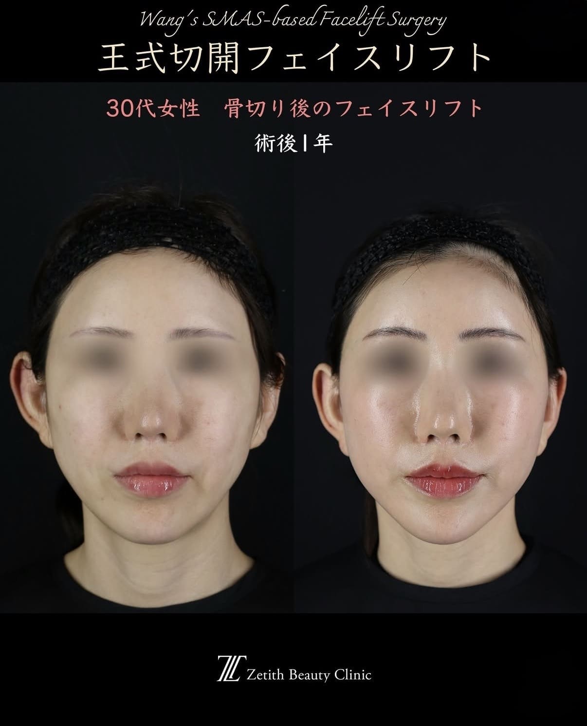 王医師による切開リフトの術前/術後1年 施術後 