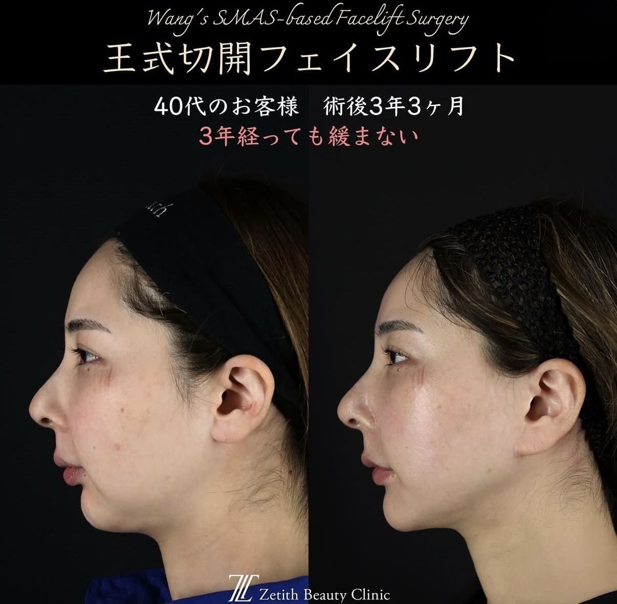 切開リフト
