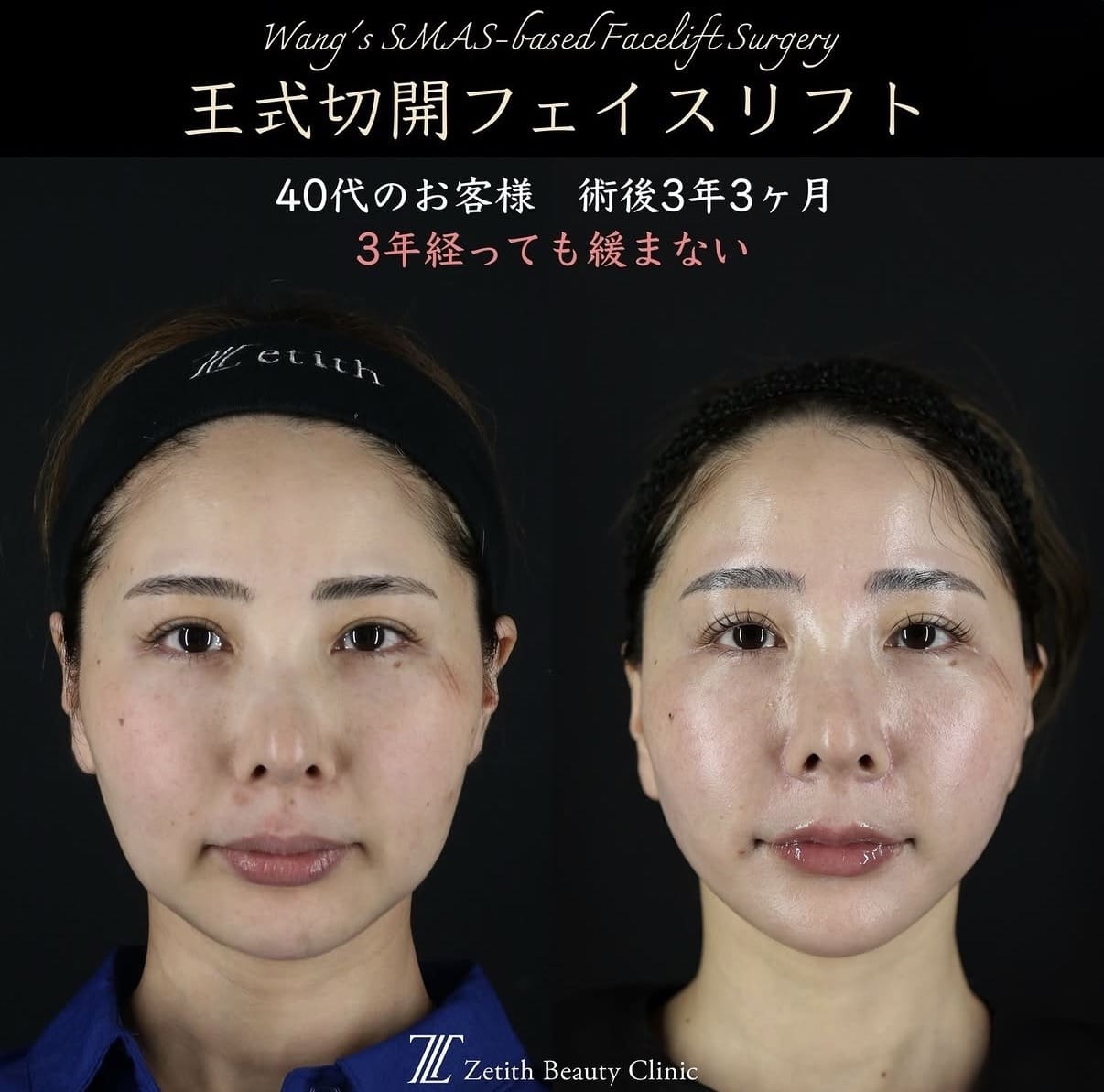 王医師による切開リフトの術前/術後3年3ヶ月 施術後 