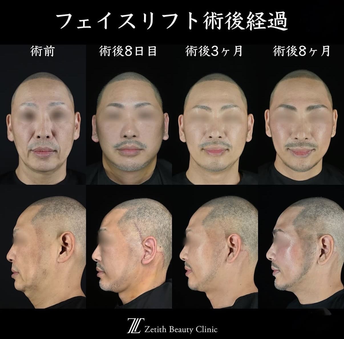 王医師による切開リフトの術前/術後8ヶ月 หลัง 