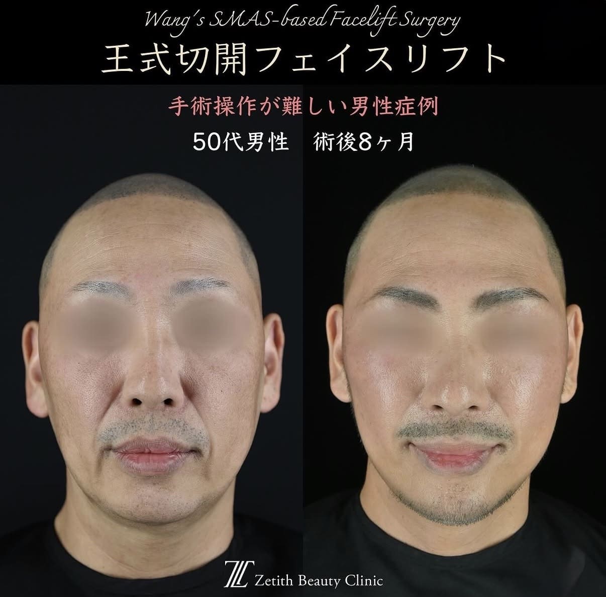 切開リフト