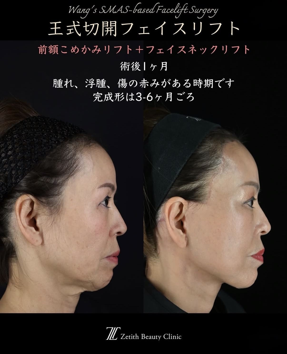 王医師による切開リフトの術前/術後1ヶ月 หลัง 