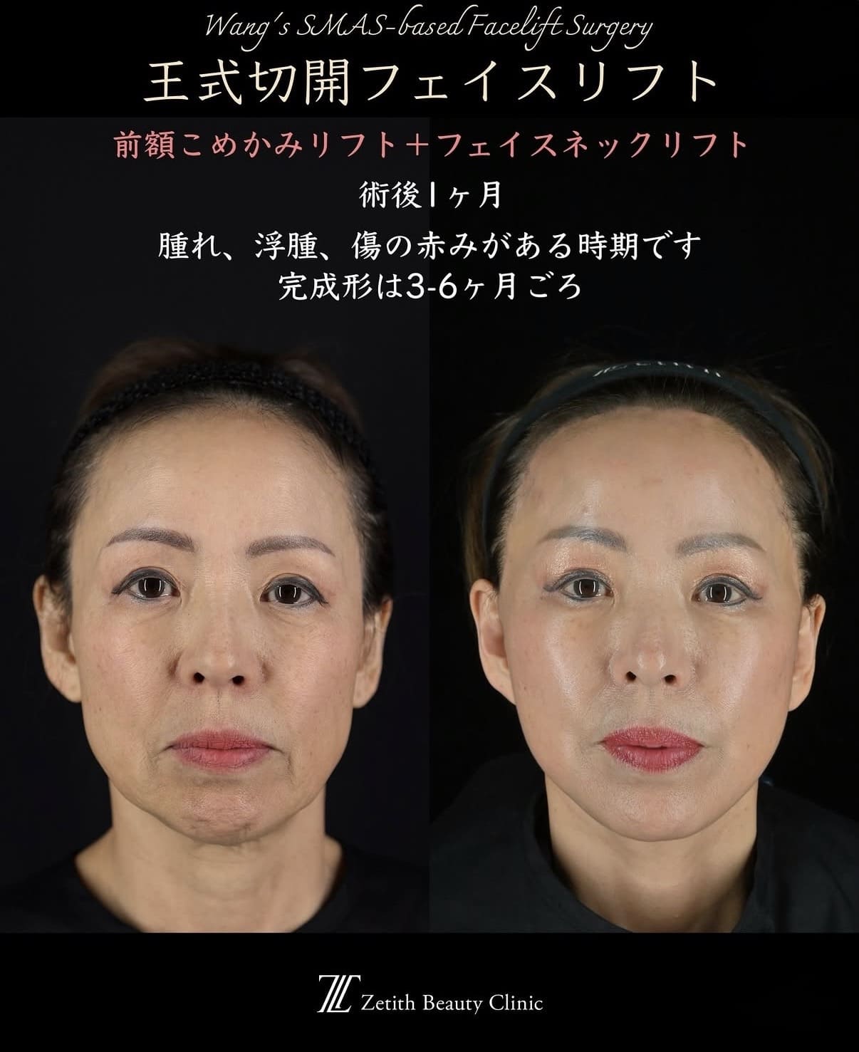 切開リフト