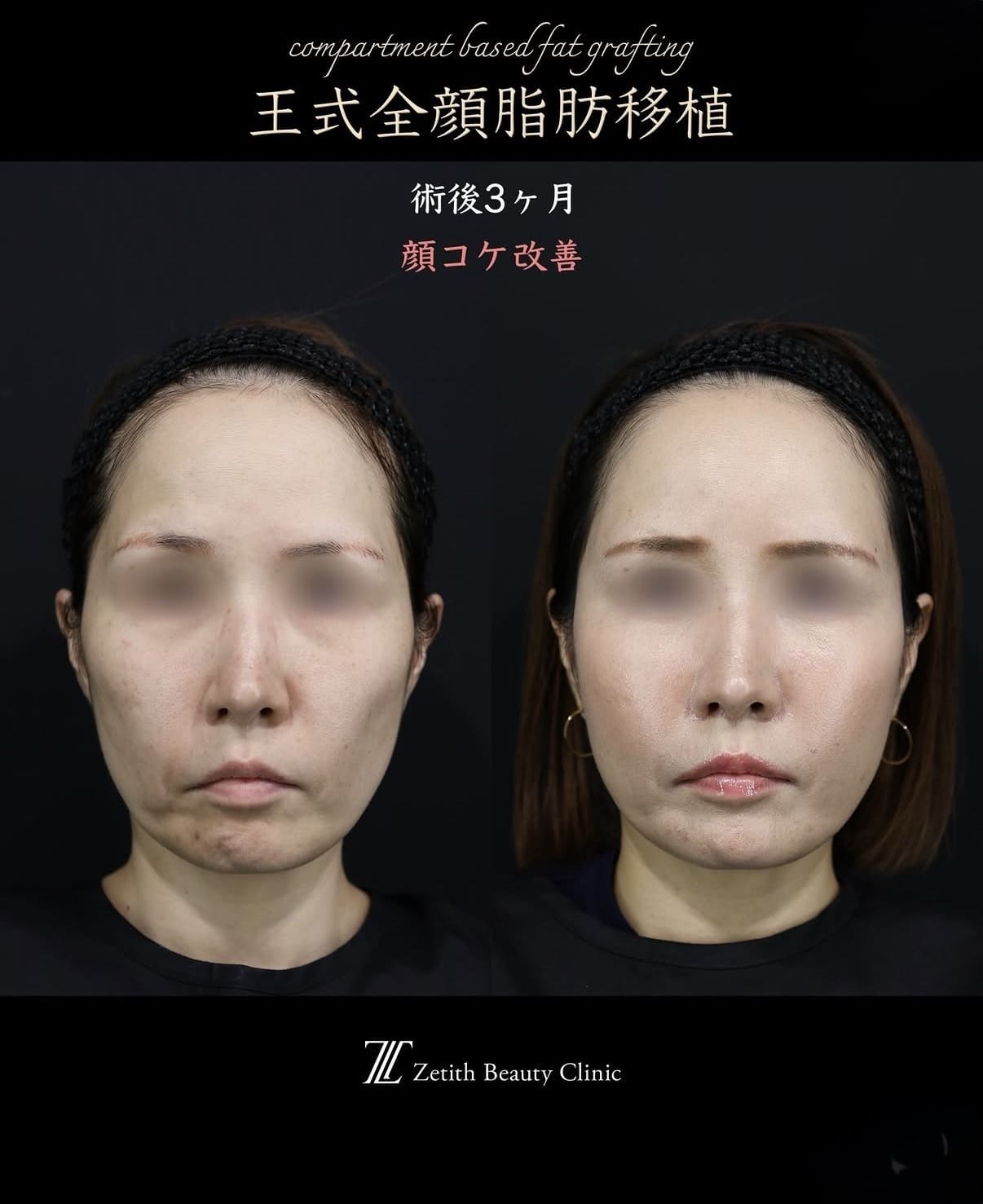 王医師による複合施術の術前/術後3ヶ月 หลัง 