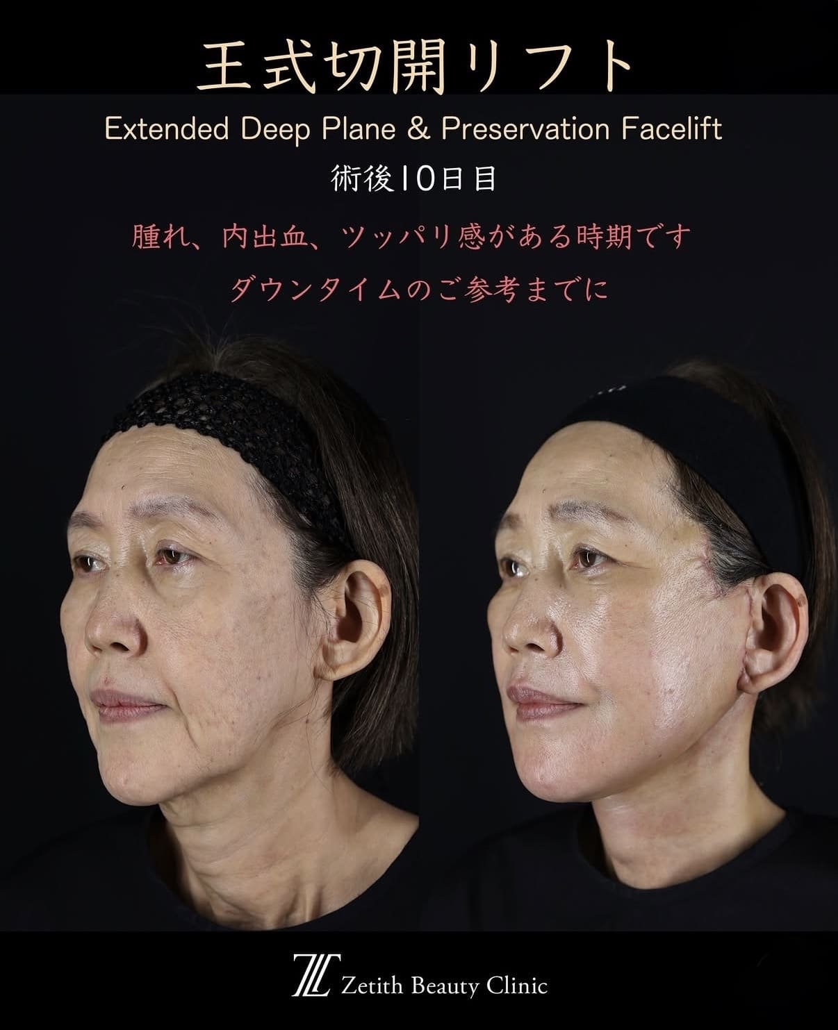 王医師による切開リフトの術前/術後10日目 Sonra 