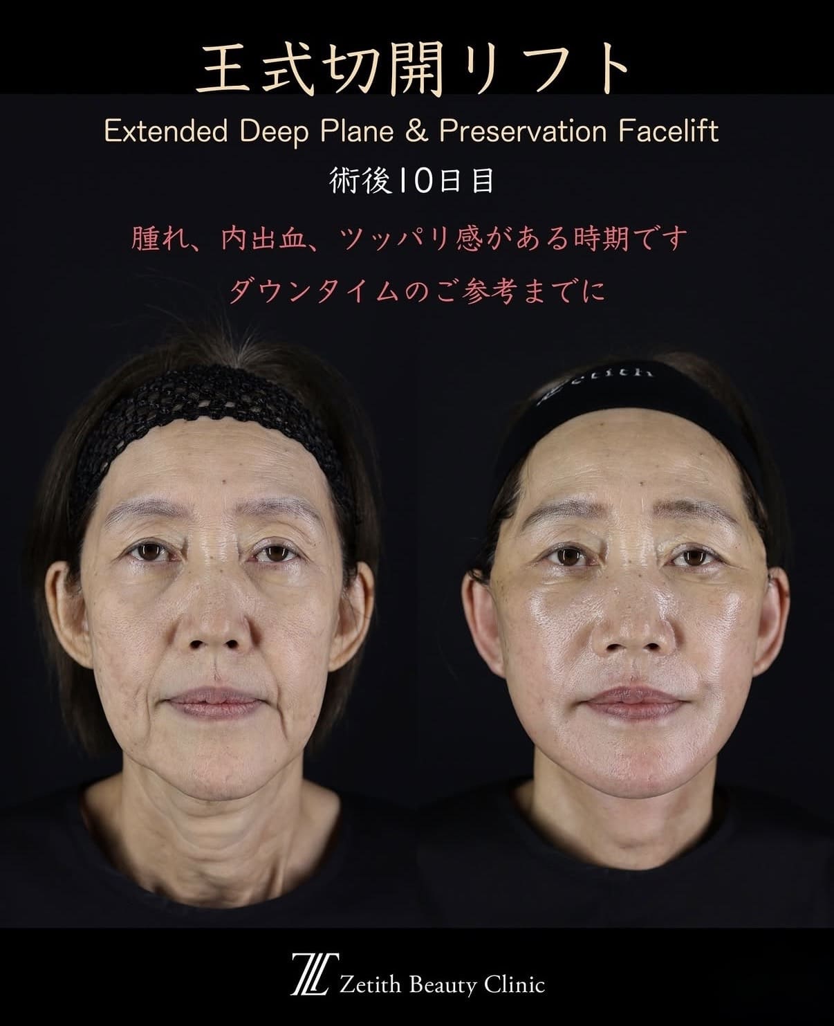 切開リフト