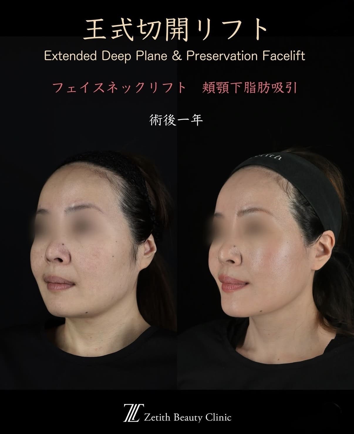 王医師による切開リフトの術前/術後1年 术后 