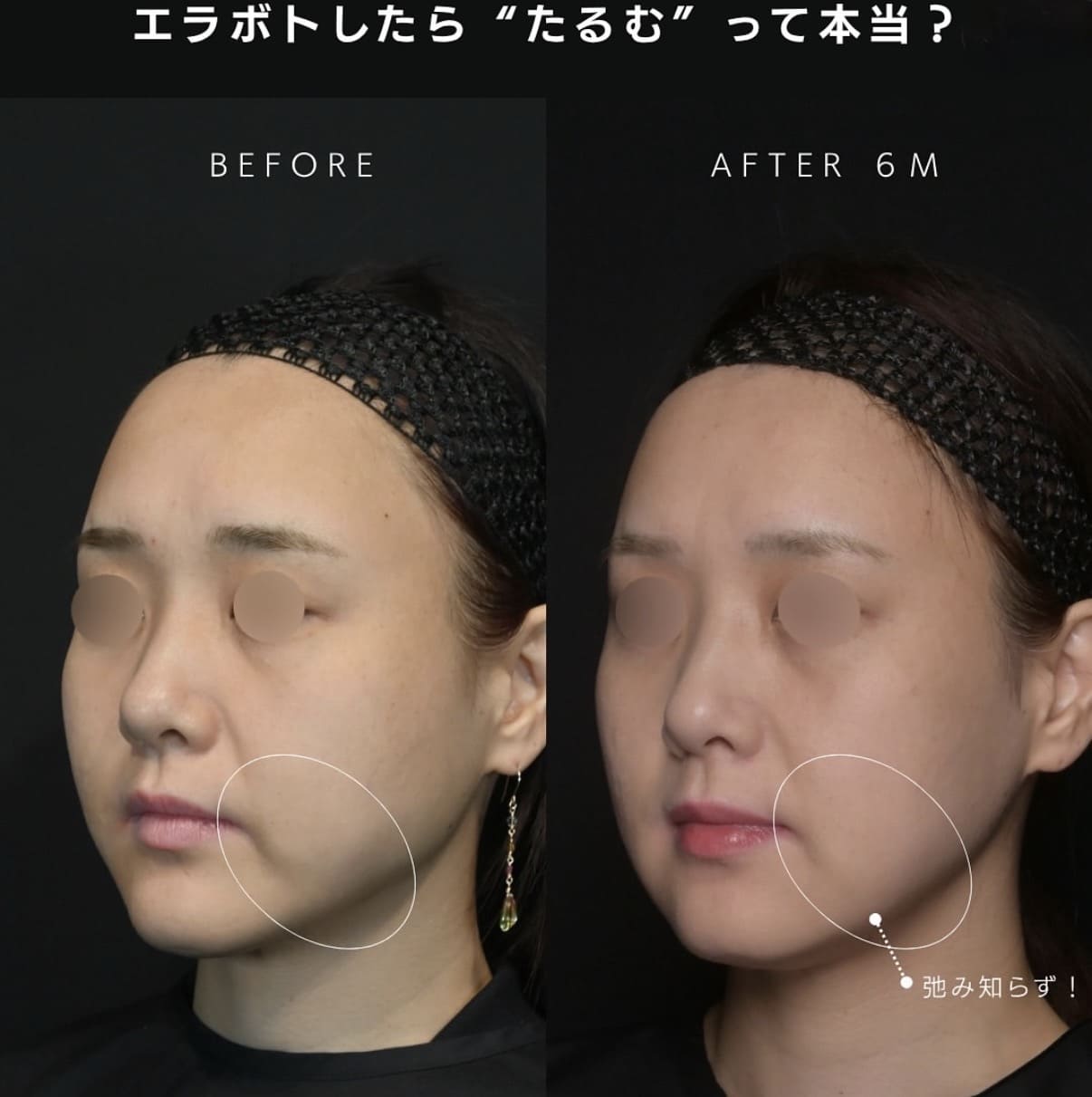 新井医師によるエラボトックスの術前/術後6ヶ月