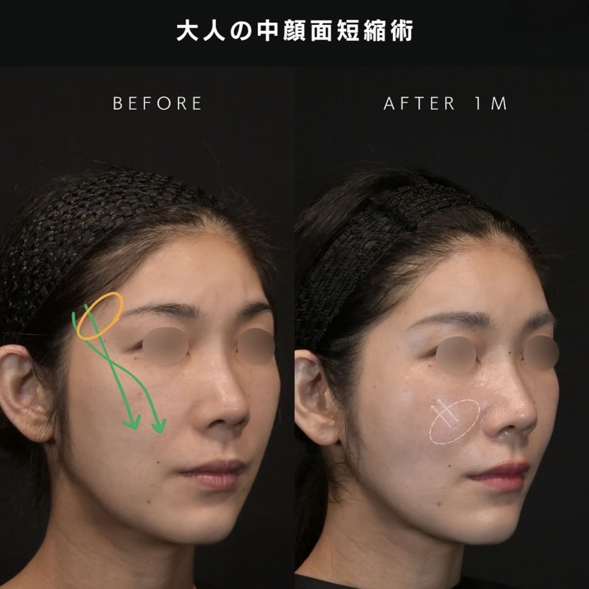 新井医師による複合施術の術前/術後1ヶ月 Дараа 