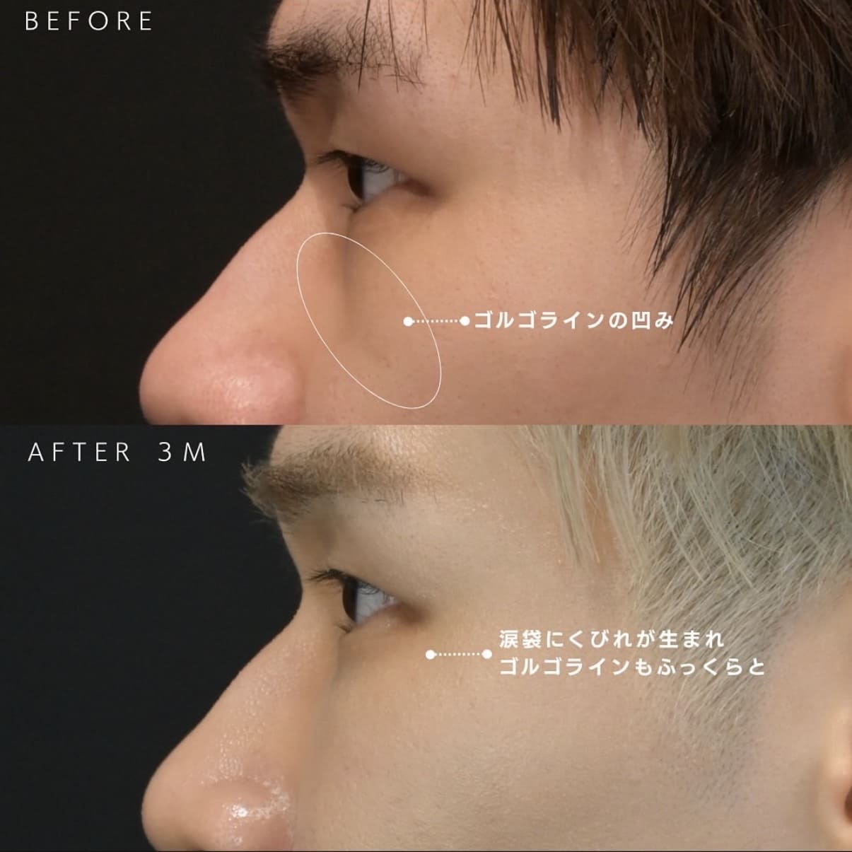 新井医師によるクマ取りの術前/術後3ヶ月 หลัง 