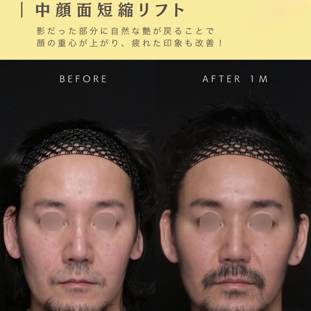 たるみ治療