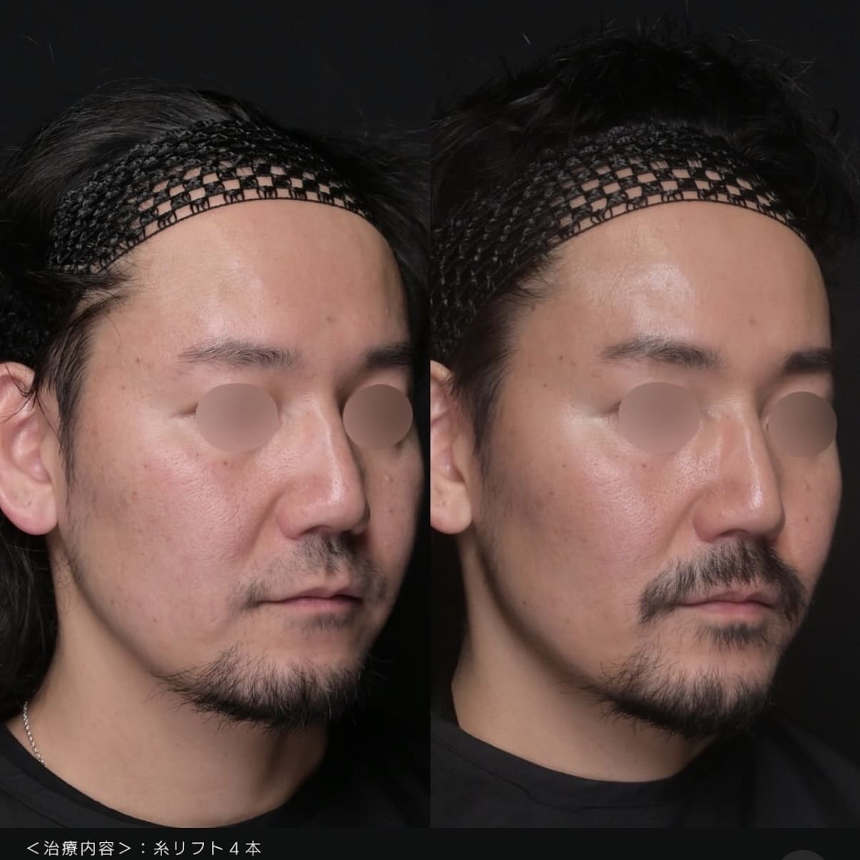 新井医師による糸リフトの術前/術後1ヶ月 Дараа 