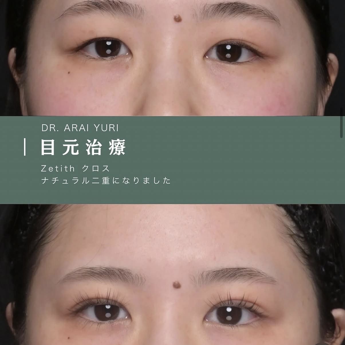 目元治療
