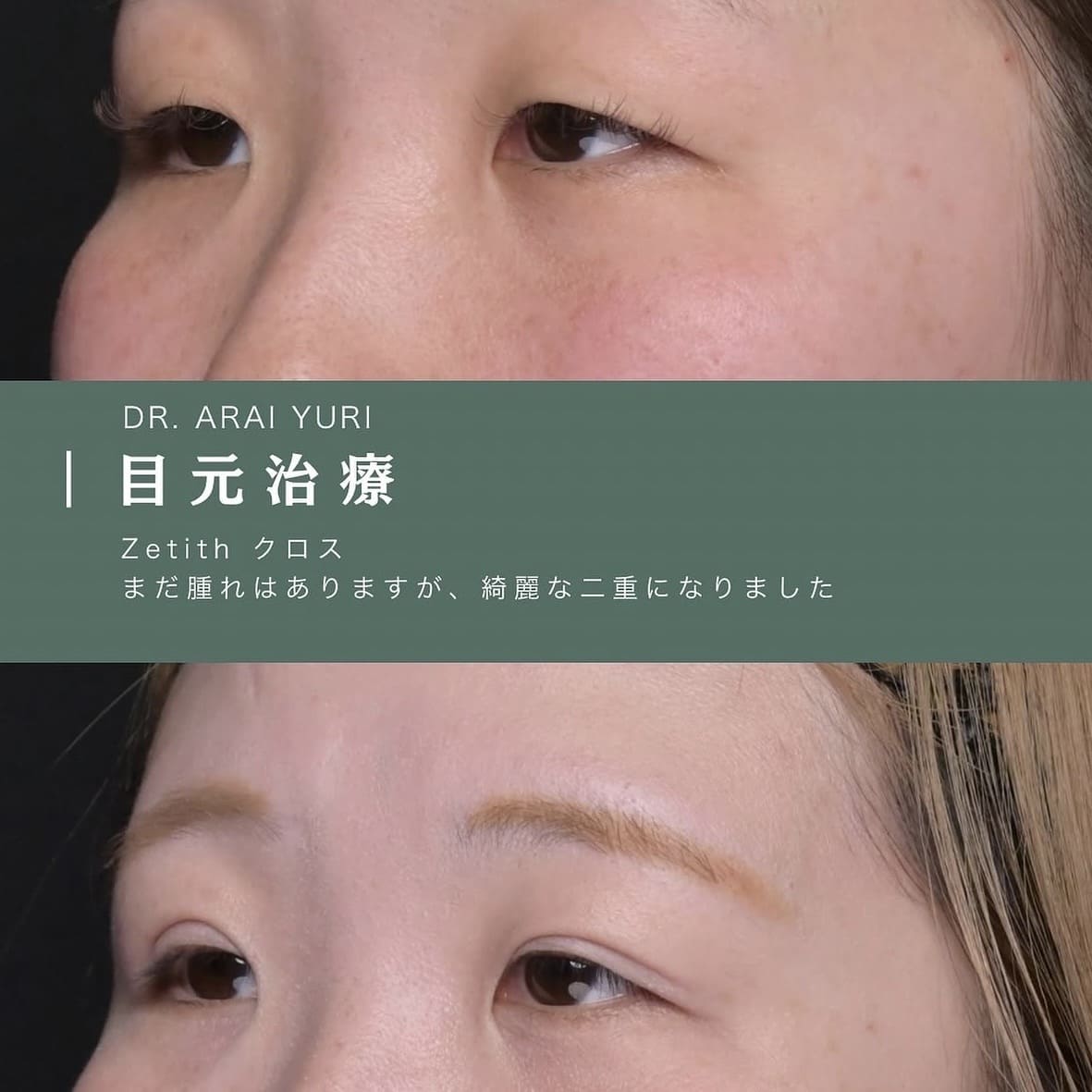 目元治療