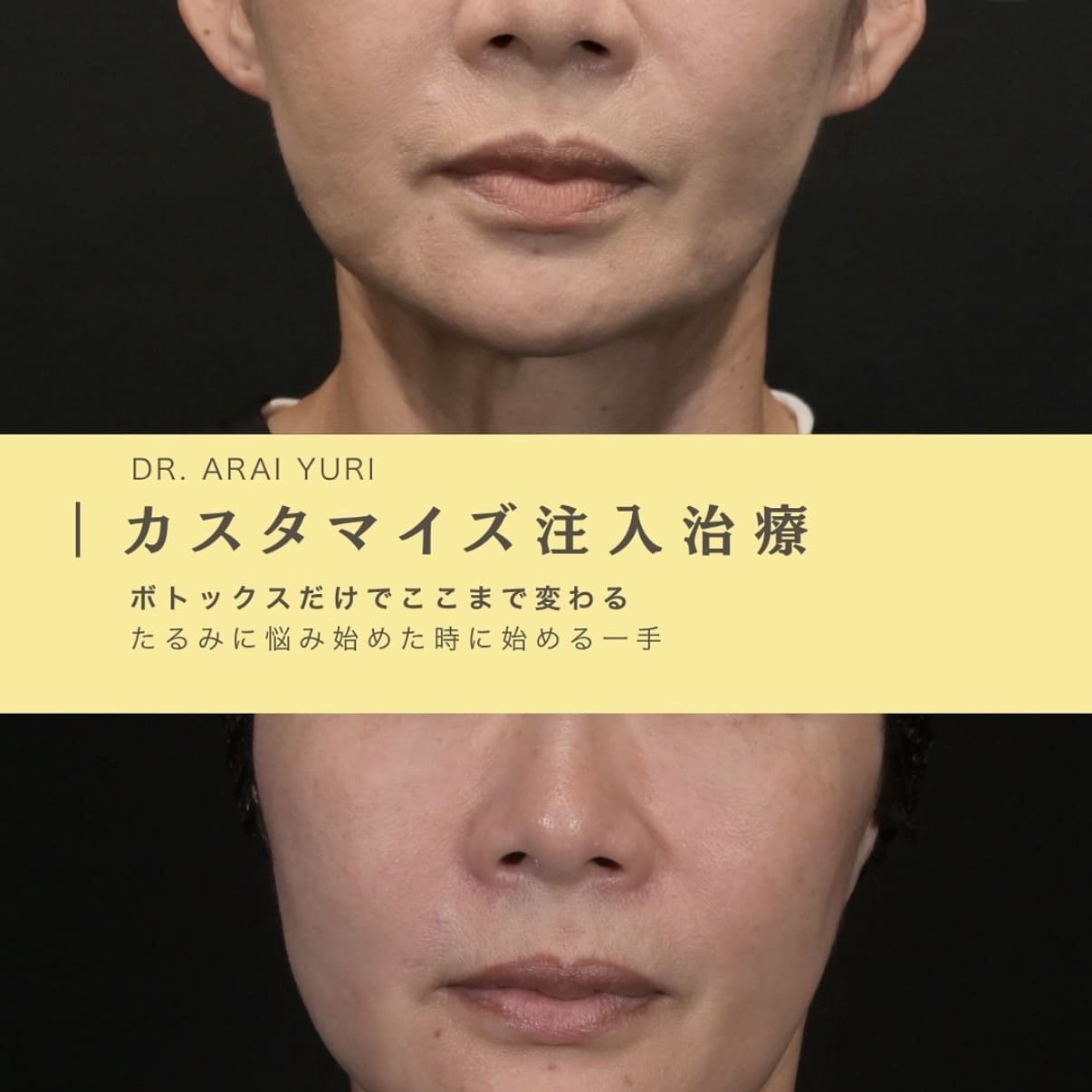 新井医師によるボトックス注入の術前/術後1ヶ月