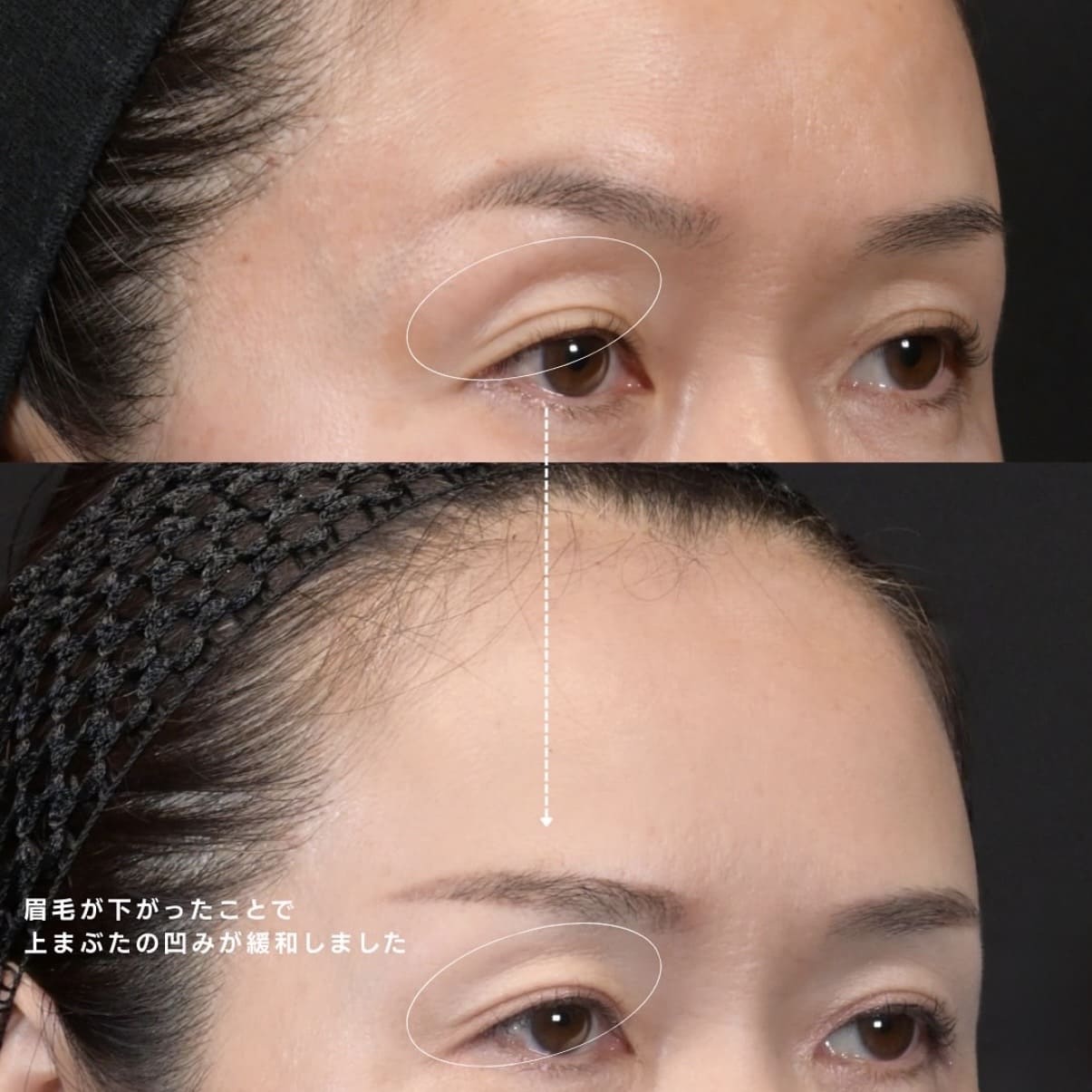 新井医師による額ボトックスの術前/術後1ヶ月 بعد 