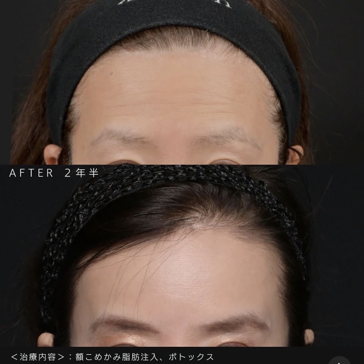 新井医師による複合施術の術前/術後2年半 หลัง 