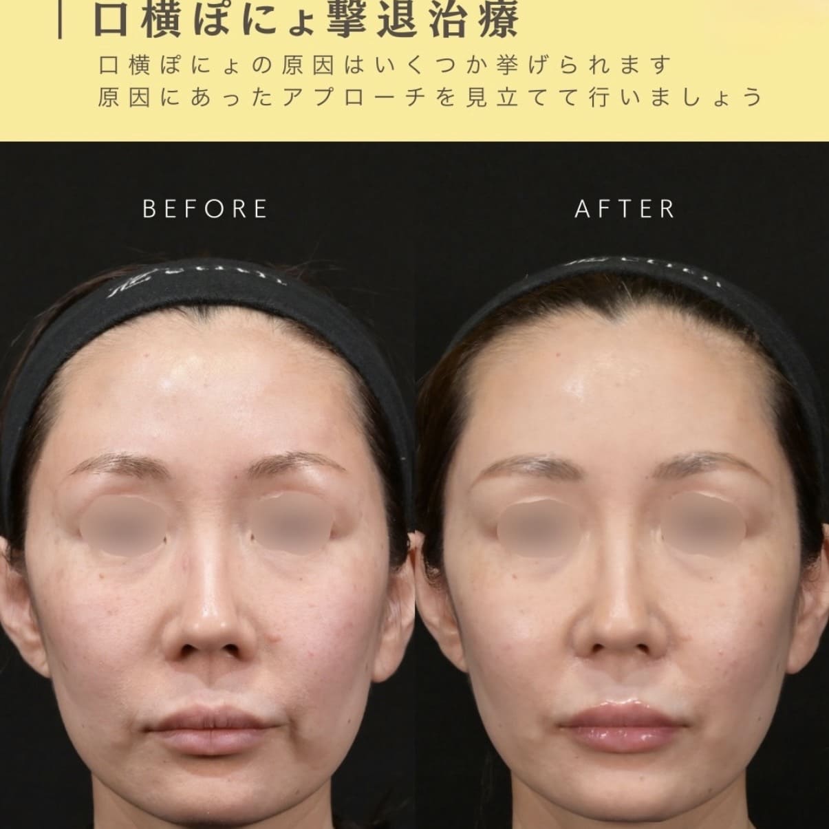 たるみ治療