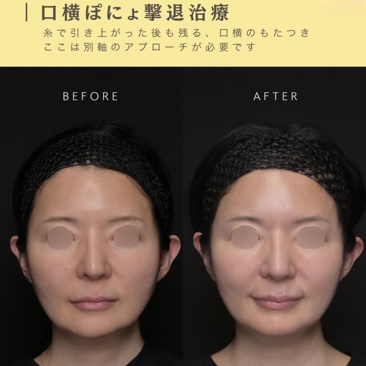 たるみ治療