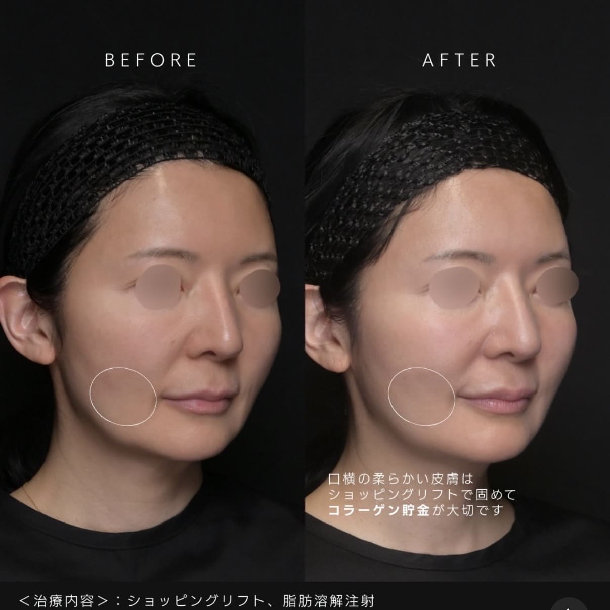 新井医師による複合施術の術前/術後1ヶ月 施術後 