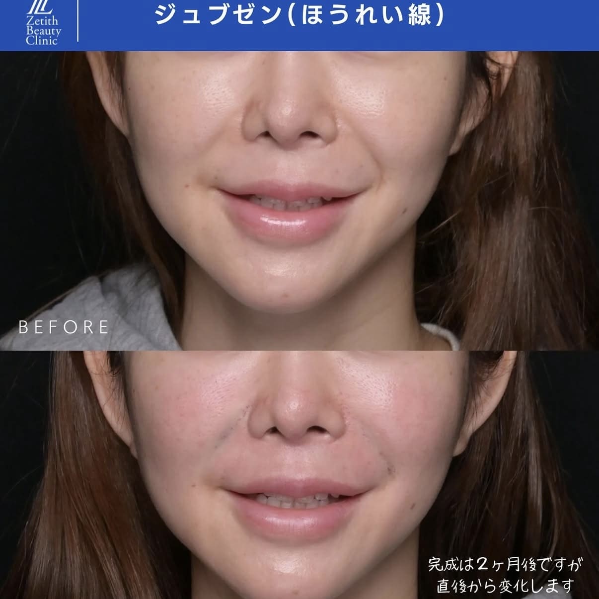 ほうれい線治療