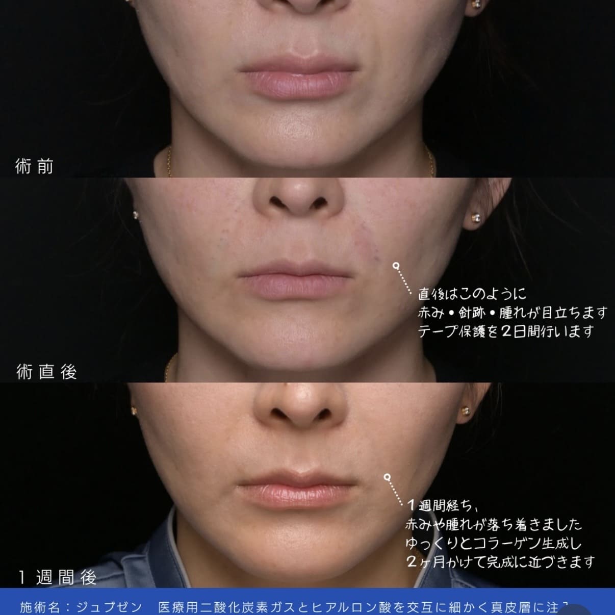 シワ線治療