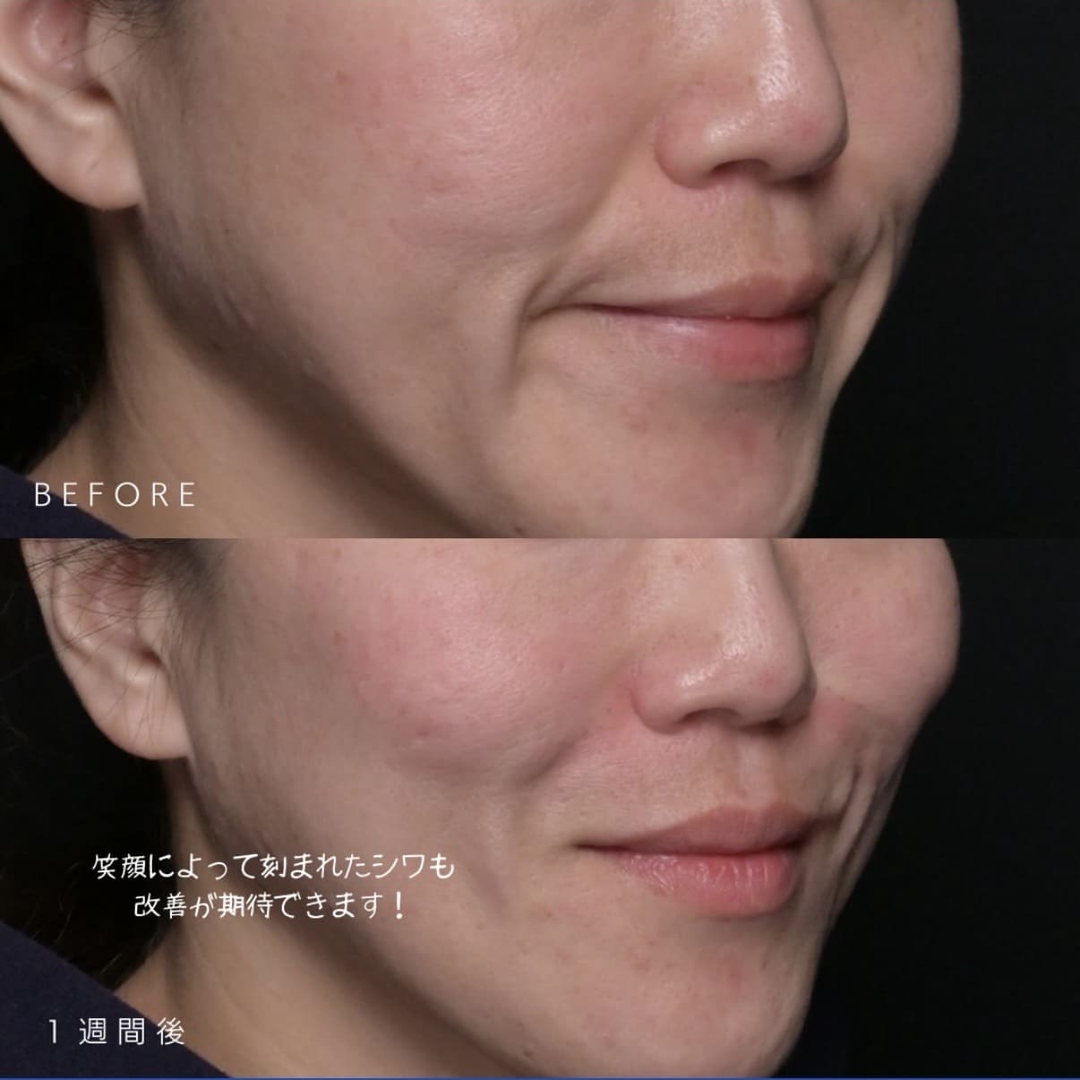 新井医師によるJUVGENの術前/術後1週間 术后 