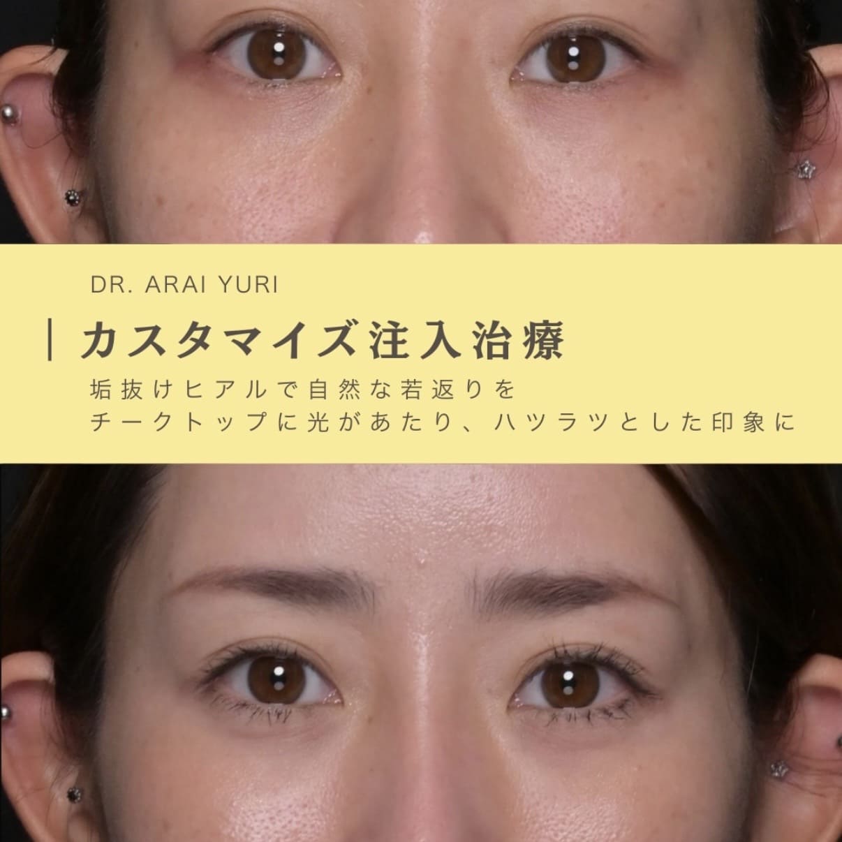 新井医師によるヒアルロン酸注入の術前/術後2ヶ月