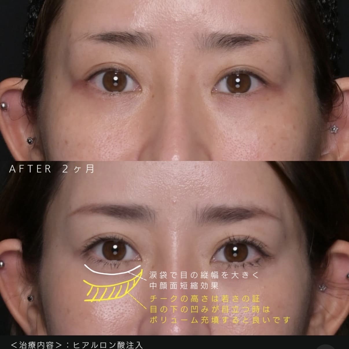 新井医師によるヒアルロン酸注入の術前/術後2ヶ月 施術後 
