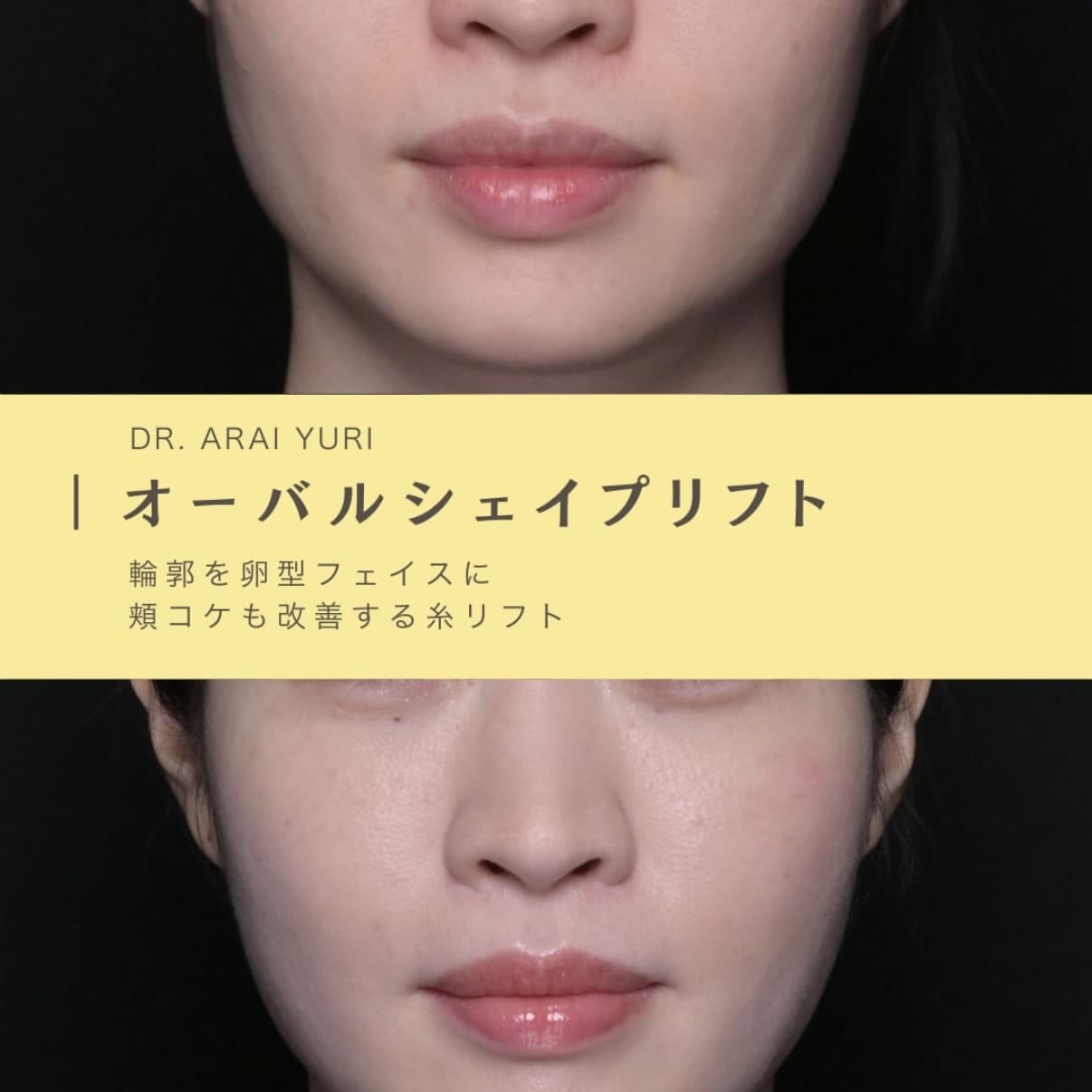 頬コケ改善