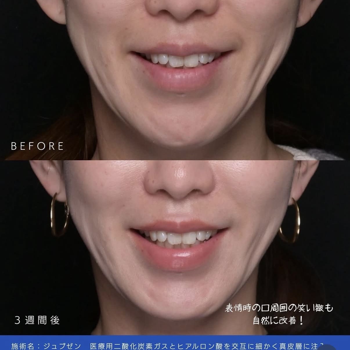 新井医師によるJUVGENの術前/術後3週間 หลัง 