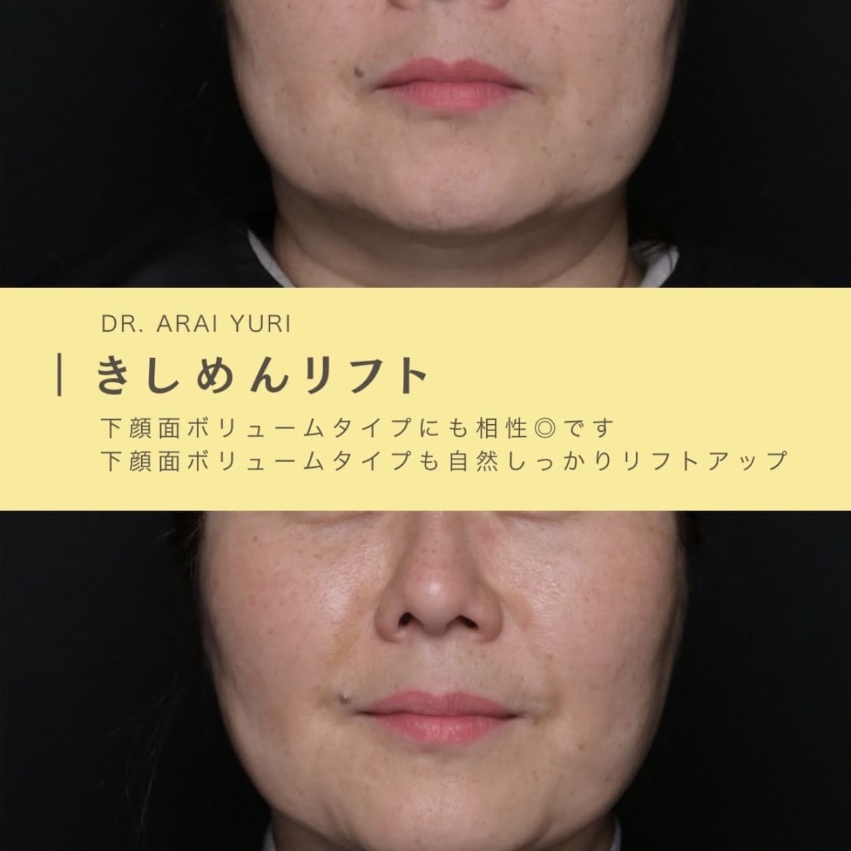 たるみ治療