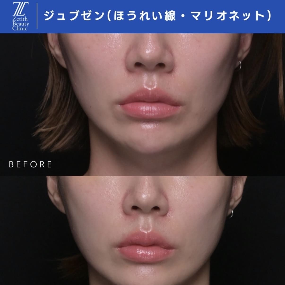 シワ治療