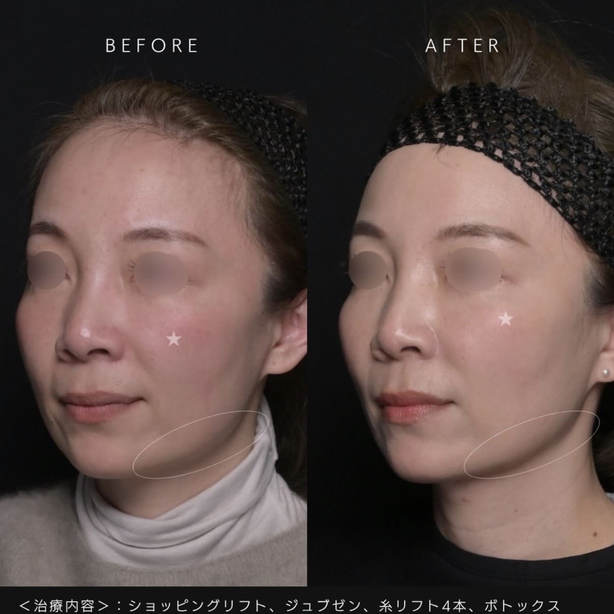 新井医師による複合施術の術前/術後1ヶ月 After 