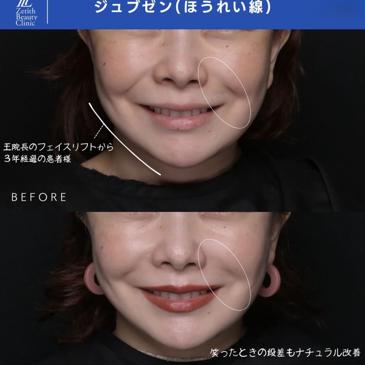 シワ治療