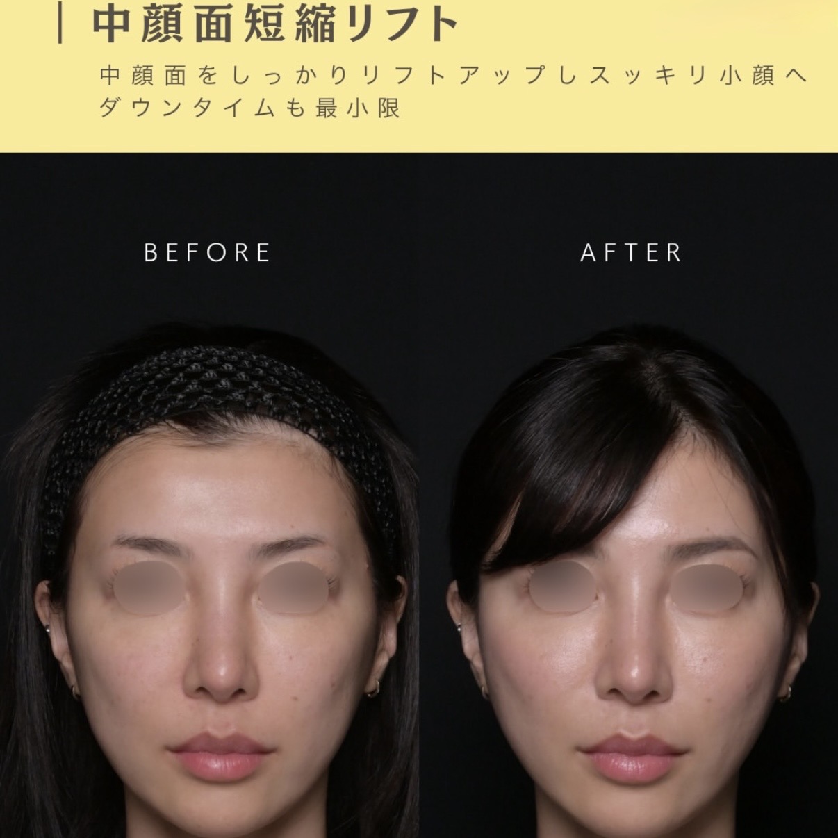 中顔面短縮