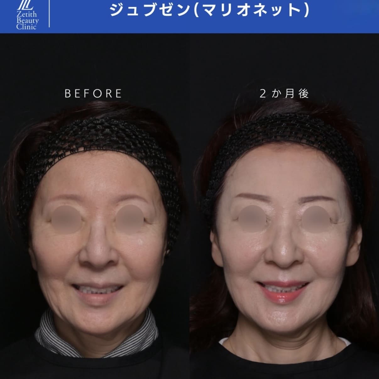 シワ治療