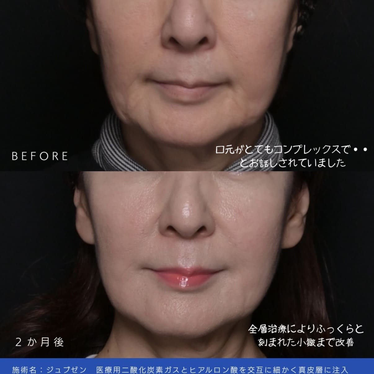 新井医師によるJUVGENの術前/術後2ヶ月 Sau 