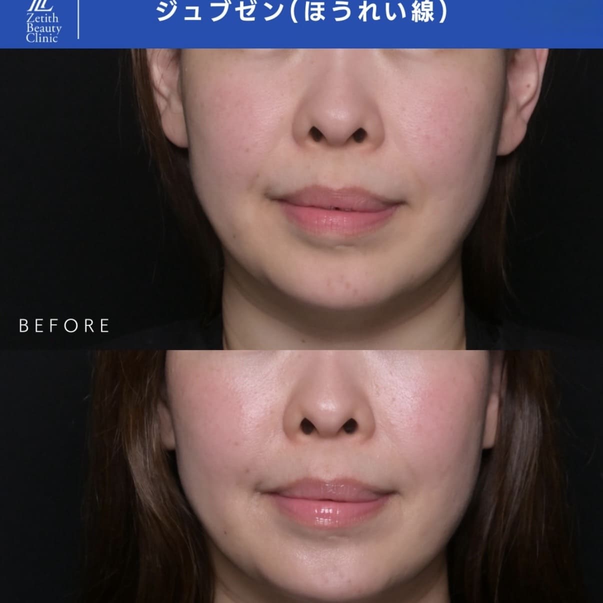 新井医師によるJUVGENの術前/術後1ヶ月 施術後 