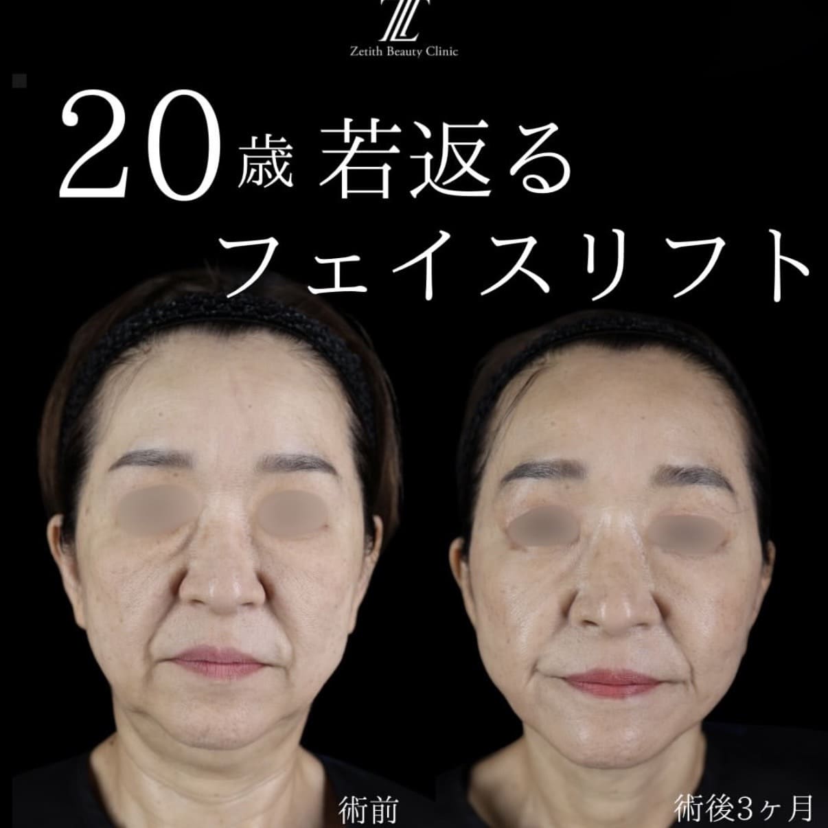 フェイスリフト